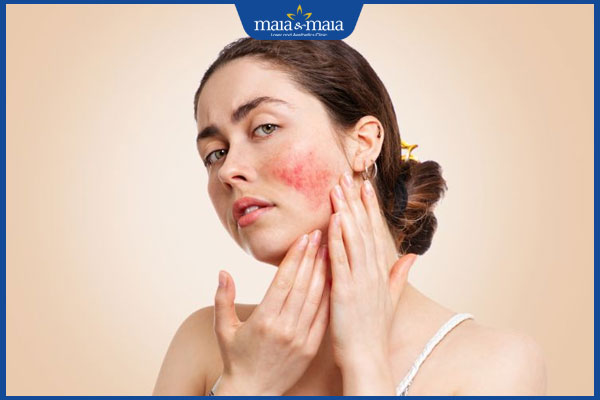 mặt nổi mụn nóng rát