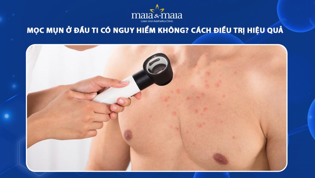 Mọc mụn ở đầu ti có nguy hiểm không? Cách điều trị hiệu quả 1 mọc mụn ở đầu ti