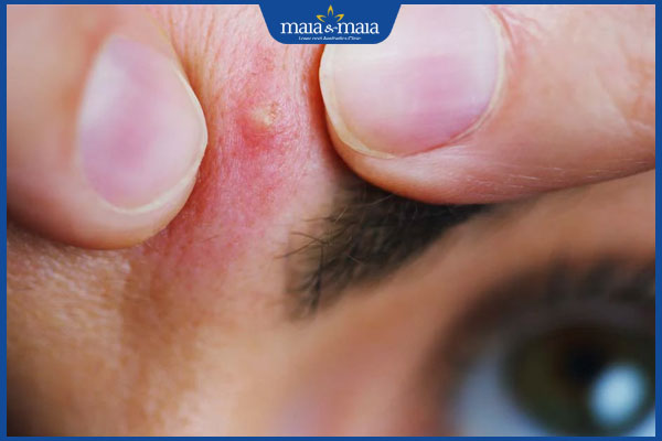 mọc mụn ở lông mày