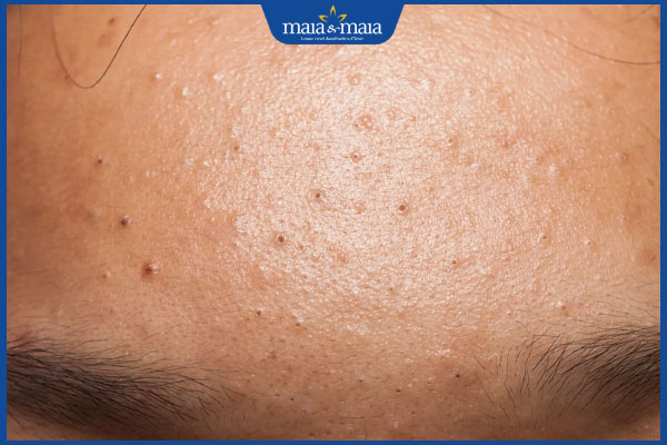 mụn ẩn trên trán