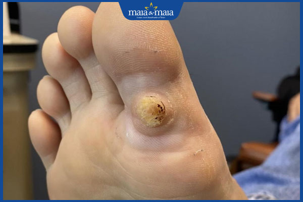 mụn cóc sưng to đau nhức