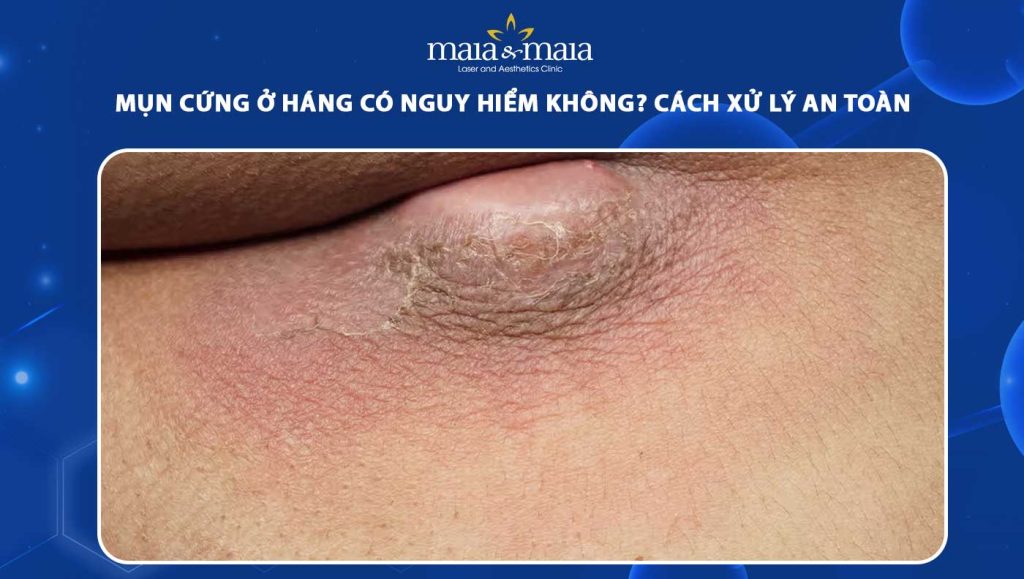 mụn cứng ở háng