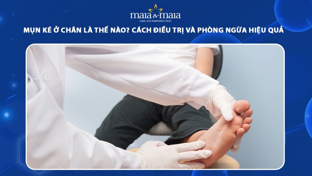 mụn ké ở chân