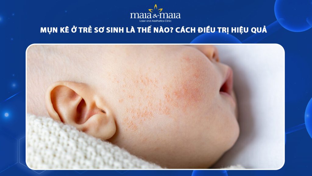 Mụn kê ở trẻ sơ sinh là như thế nào? Cách điều trị hiệu quả 1 mụn kê ở trẻ sơ sinh