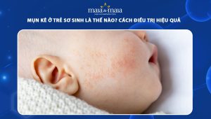mụn kê ở trẻ sơ sinh