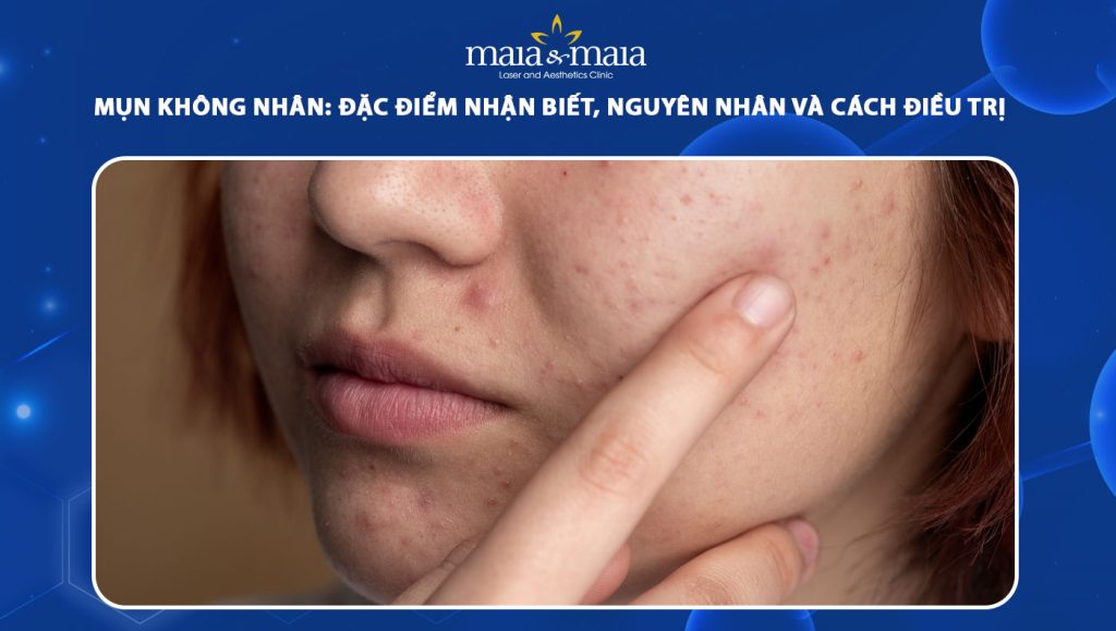 Mụn không nhân: Nhận biết, nguyên nhân và cách điều trị 1 mụn không nhân