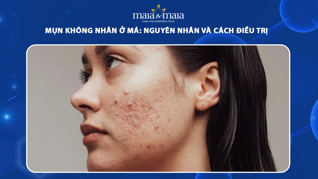 Mụn không nhân ở má: Nguyên nhân và cách điều trị 1 mụn không nhân ở má