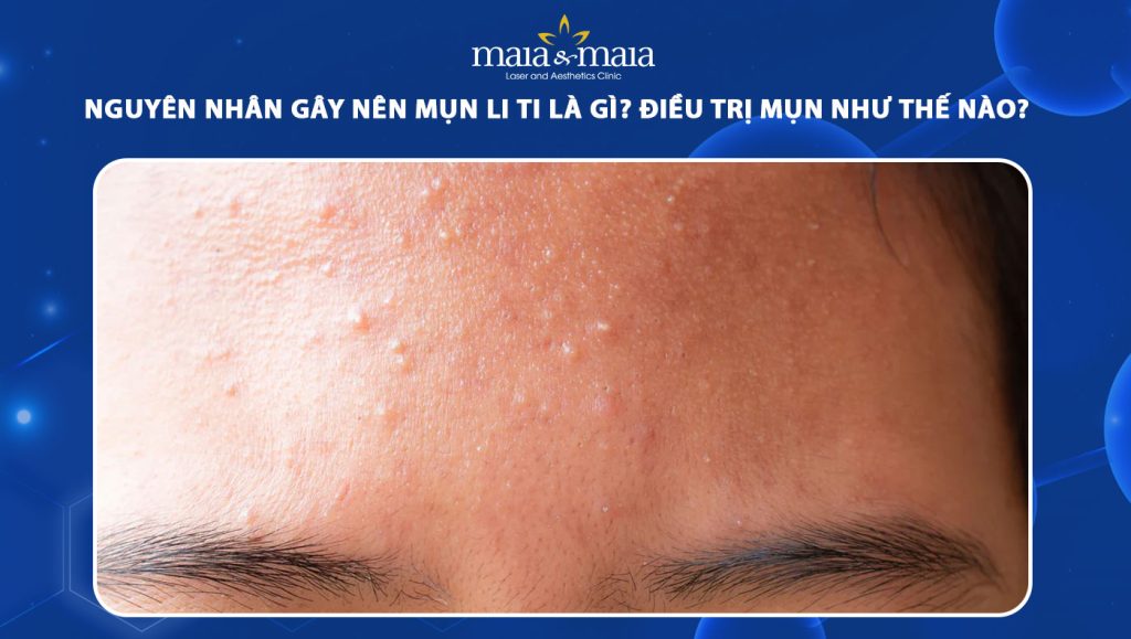 Nguyên nhân gây nên mụn li ti là gì? Điều trị như thế nào? 1 mụn li ti