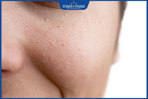 Nguyên nhân gây nên mụn li ti là gì? Điều trị như thế nào? 2 mụn li ti trên mặt