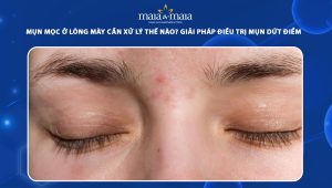 mụn mọc ở lông mày