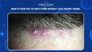 mụn ở chân tóc