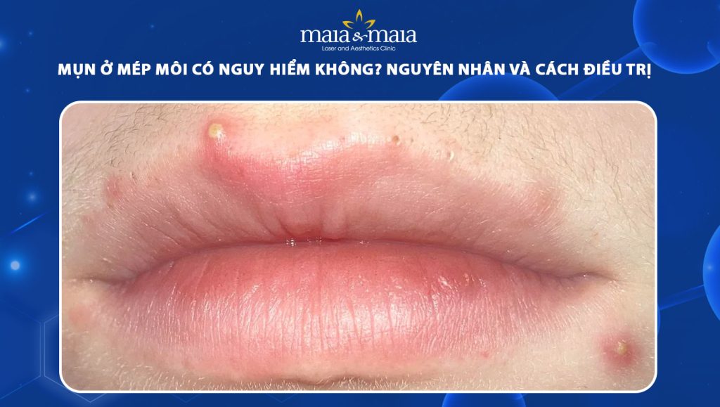 mụn ở mép môi