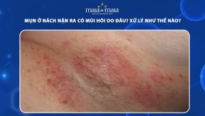 mụn ở nách nặn ra có mùi hôi
