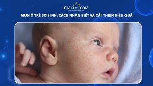 mụn ở trẻ sơ sinh
