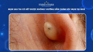 mụn sau tai