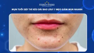 mụn tuổi dậy thì kéo dài bao lâu