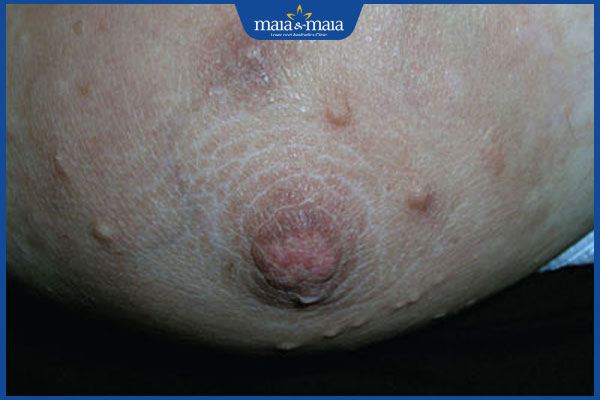 Mọc mụn ở đầu ti có nguy hiểm không? Cách điều trị hiệu quả 2 mụn xuất hiện ở đầu ti