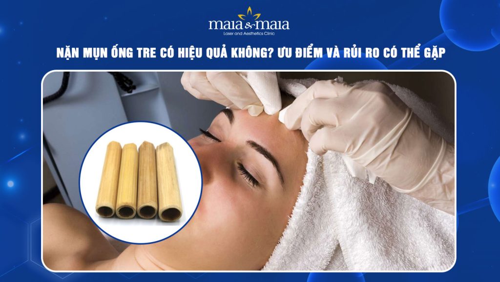 nặn mụn ống tre