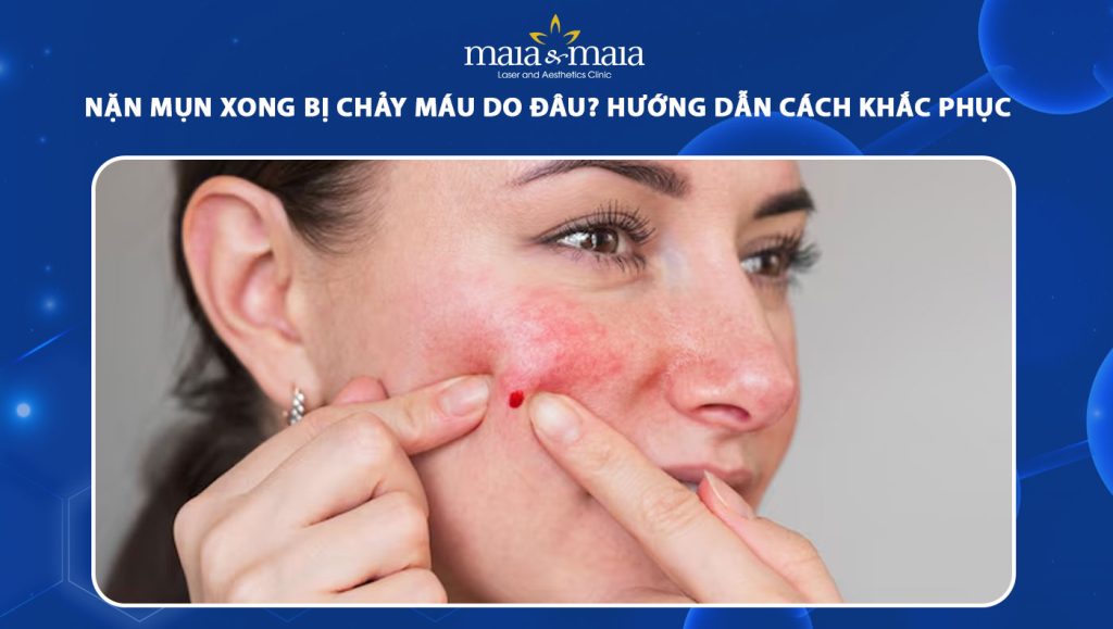 Nặn mụn xong bị chảy máu do đâu? Hướng dẫn cách khắc phục 1 nặn mụn xong bị chảy máu
