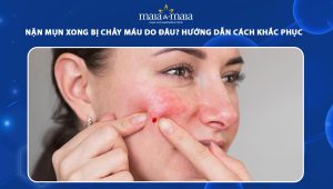 nặn mụn xong bị chảy máu