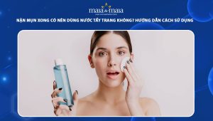 nặn mụn xong có nên dùng nước tẩy trang