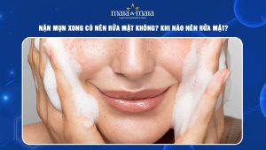 Nặn mụn xong có nên rửa mặt không