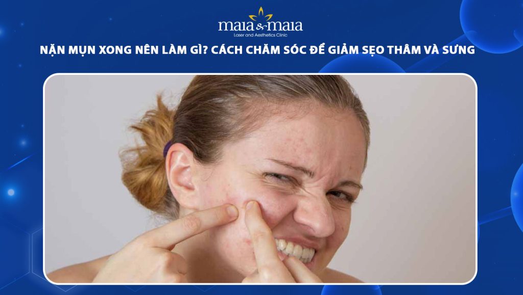 Nặn mụn xong nên làm gì? Cách chăm sóc để giảm thâm sẹo 1 nặn mụn xong nên làm gì