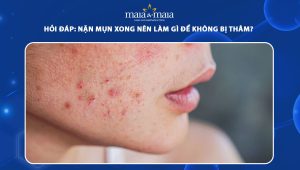 nặn mụn xong nên làm gì để không bị thâm