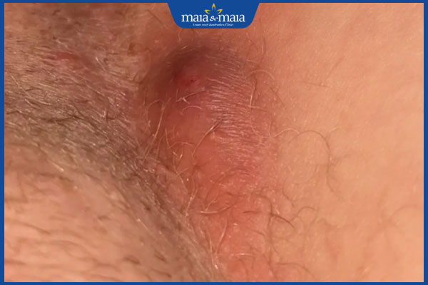 nguy hiểm mụn cứng ở háng