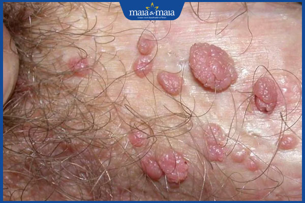 nhận biết mụn cóc sinh dục