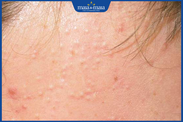 Mụn hạt kê là gì? Giải pháp xử lý mụn an toàn và hiệu quả 2 nhận biết mụn hạt kê