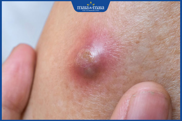 nổi mụn cứng ở háng