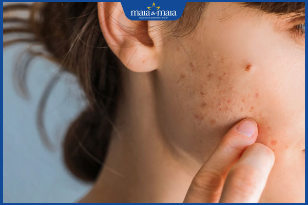 Mụn không nhân: Nhận biết, nguyên nhân và cách điều trị 2 nổi mụn không nhân ở má