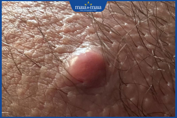 Tinh hoàn nổi mụn cứng có nguy hiểm không? Điều trị thế nào? 2 nổi mụn ở tinh hoàn