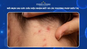 nổi mụn sau gáy
