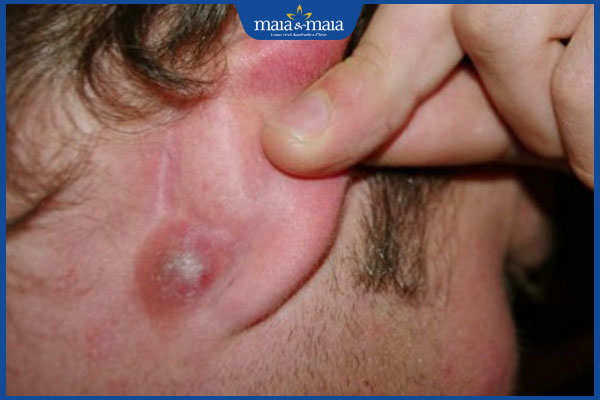 Mụn sau tai có hết được không? Cách điều trị và phòng ngừa 2 nổi mụn sau tai