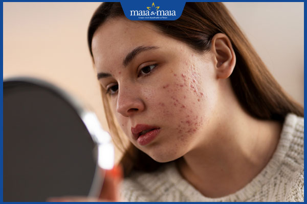 nổi mụn trong kỳ kinh nguyệt