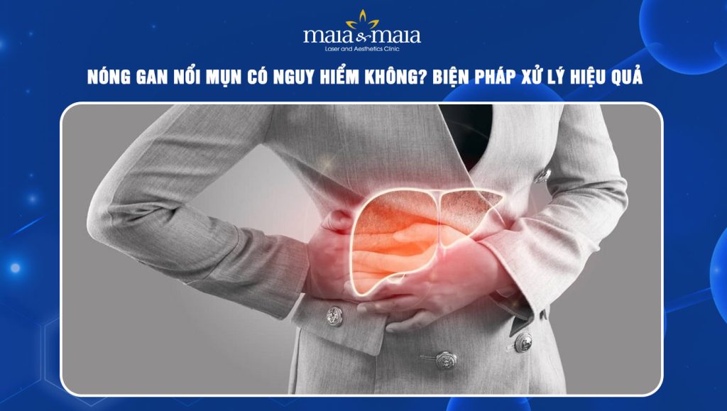Nóng gan nổi mụn có nguy hiểm không? Cách xử lý hiệu quả 1 nóng gan nổi mụn