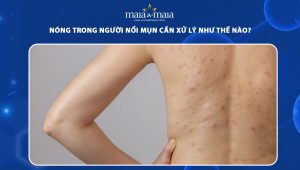 nóng trong người nổi mụn