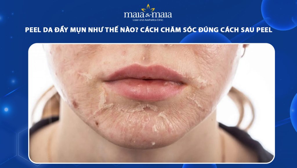 peel da đẩy mụn