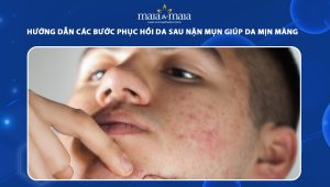 phục hồi da sau nặn mụn