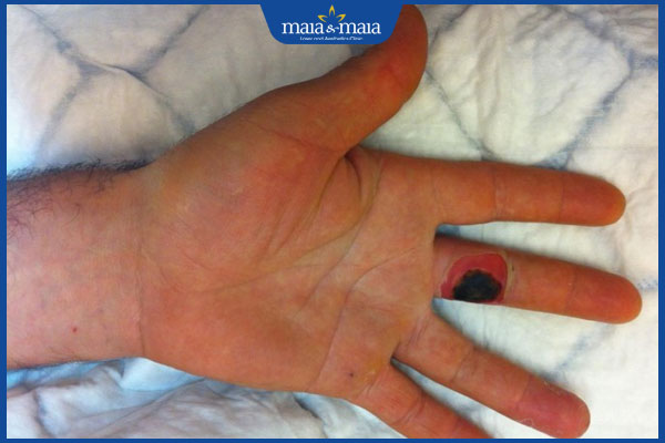 rủi ro khi trị mụn cóc bằng axit