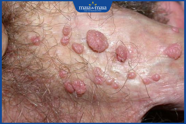 Tinh hoàn nổi mụn cứng có nguy hiểm không? Điều trị thế nào? 3 sùi mào gà ở vùng kín