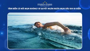 tắm biển có nổi mụn không