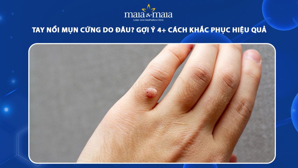 Tay nổi mụn cứng do đâu? Gợi ý 4 cách khắc phục hiệu quả 1 tay nổi mụn cứng