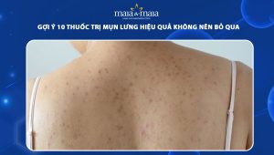 thuốc trị mụn lưng