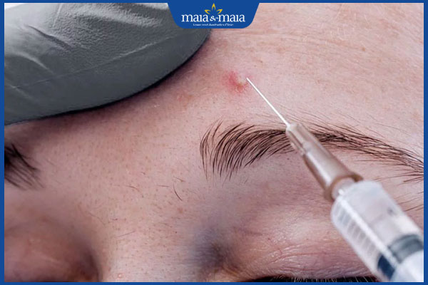 Tiêm meso trị mụn có đau không? Hiệu quả trong bao lâu? 7 tiêm trị mụn