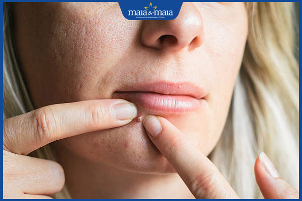 Có nên nặn mụn không? Lưu ý cách thực hiện và chăm sóc da 2 tiến hành nặn mụn