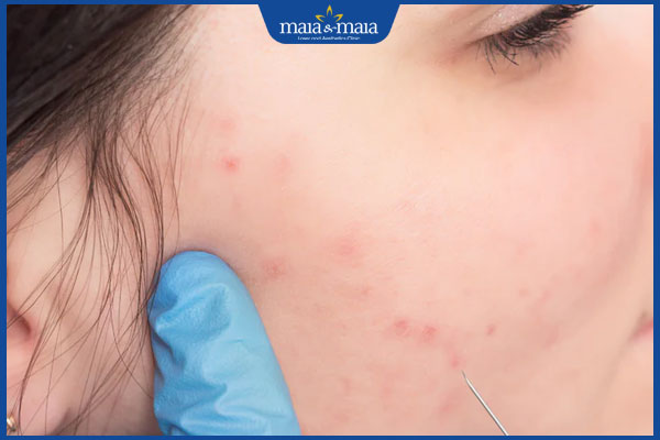 Tiêm Meso trị mụn giá bao nhiêu? Yếu tố ảnh hưởng đến chi phí 2 tiến hành tiêm meso trị mụn