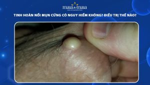 tinh hoàn nổi mụn cứng